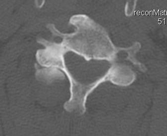 Unilateral Facet Joint Dislocation CT